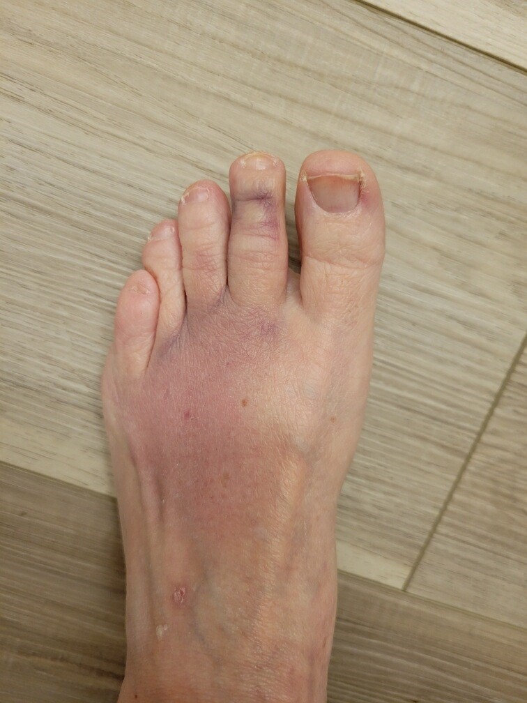 Cathy Gassman'S Foot Shortly After Slipping On Ice On Her Balcony (Courtesy Of Cathy Gassman)